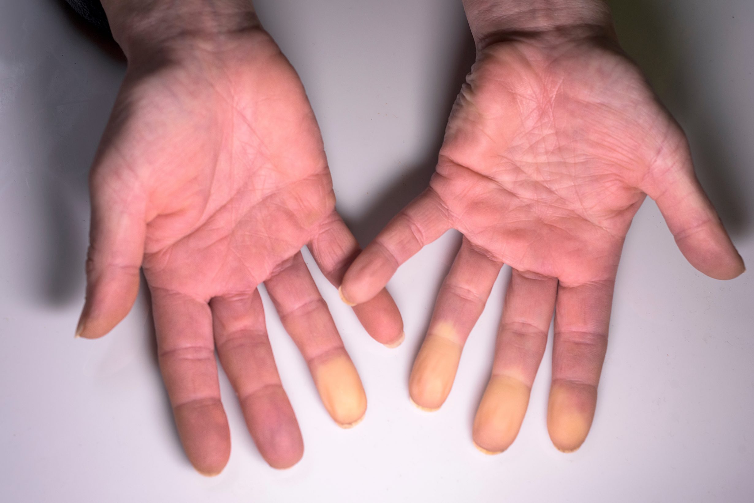 differenza tra sindrome e malattia